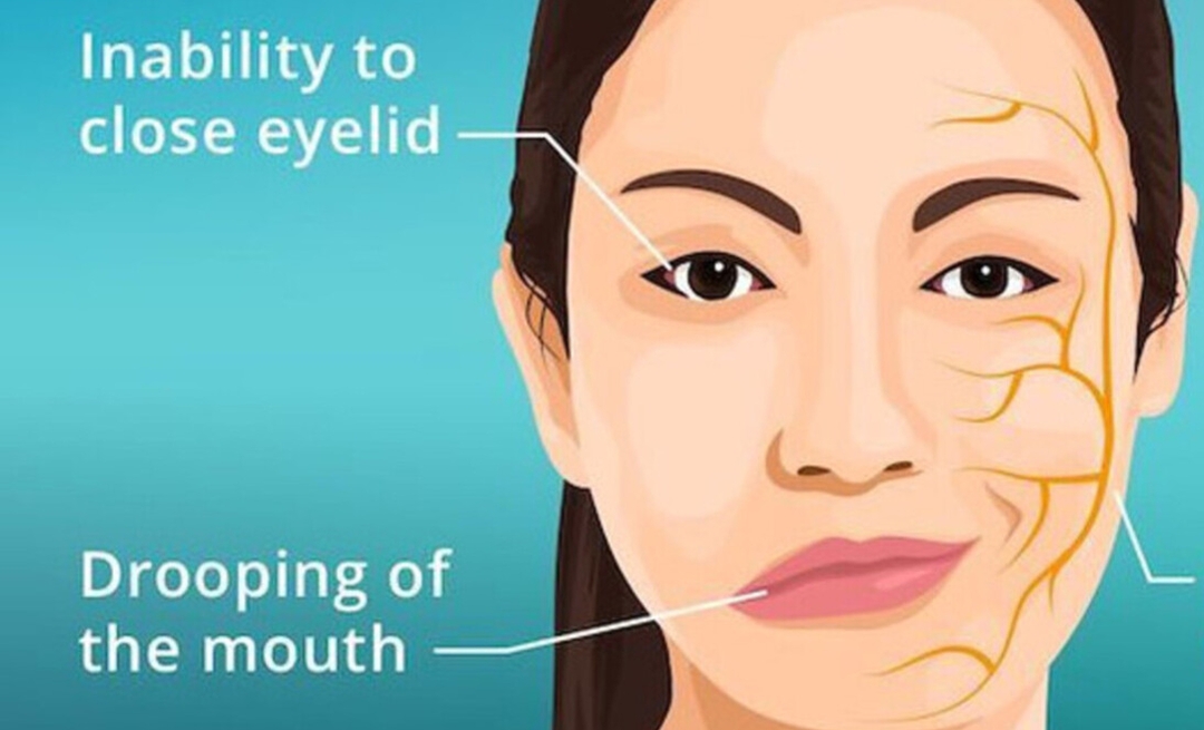 Bell's palsy: what is the link with the eyes?