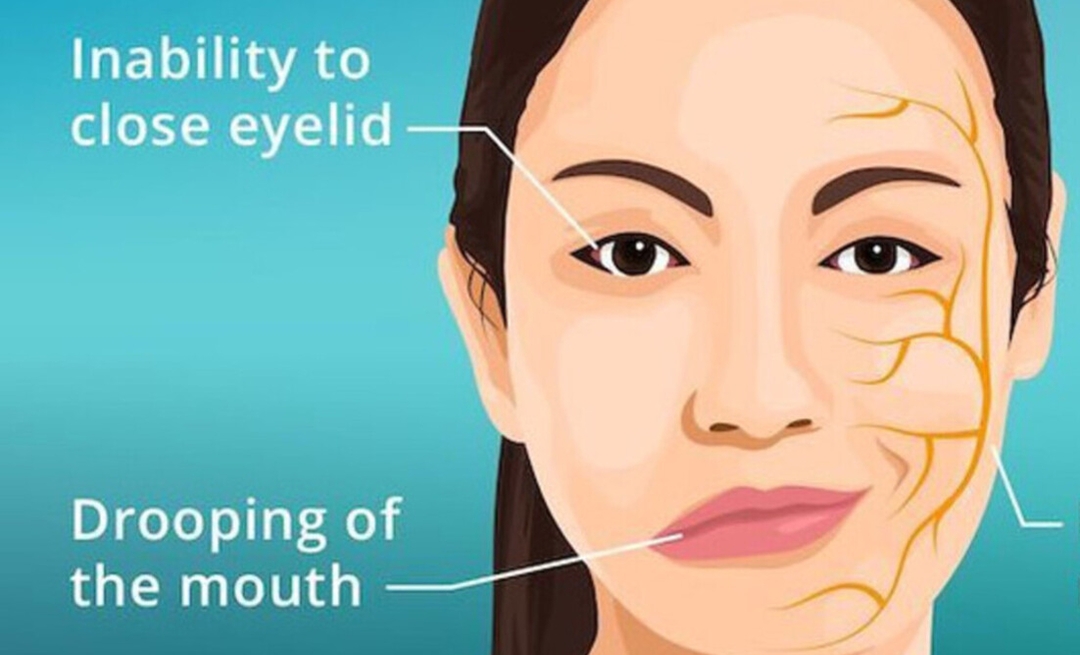 La paralysie de Bell : quel lien avec les yeux ?