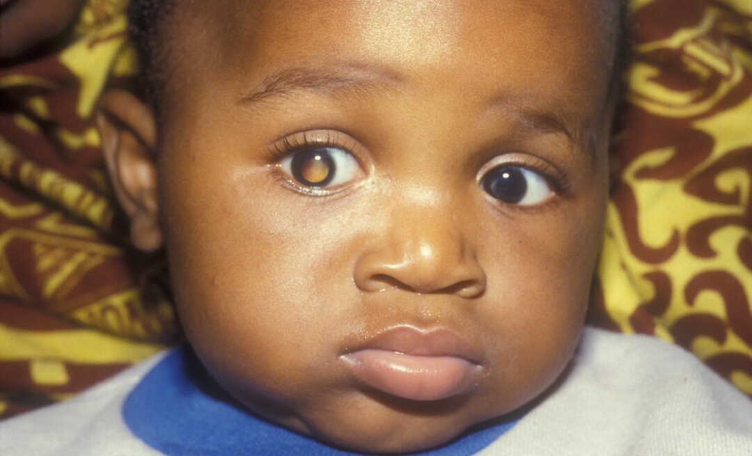 Retinoblastoma: what is it?