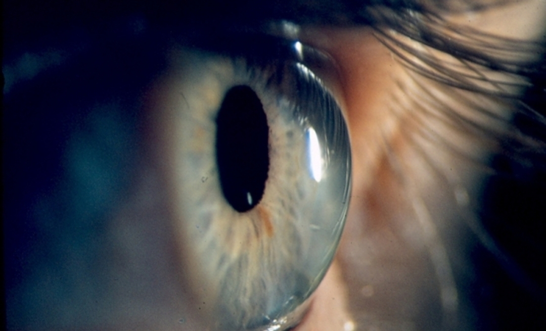 Too much eye rubbing can distort the cornea